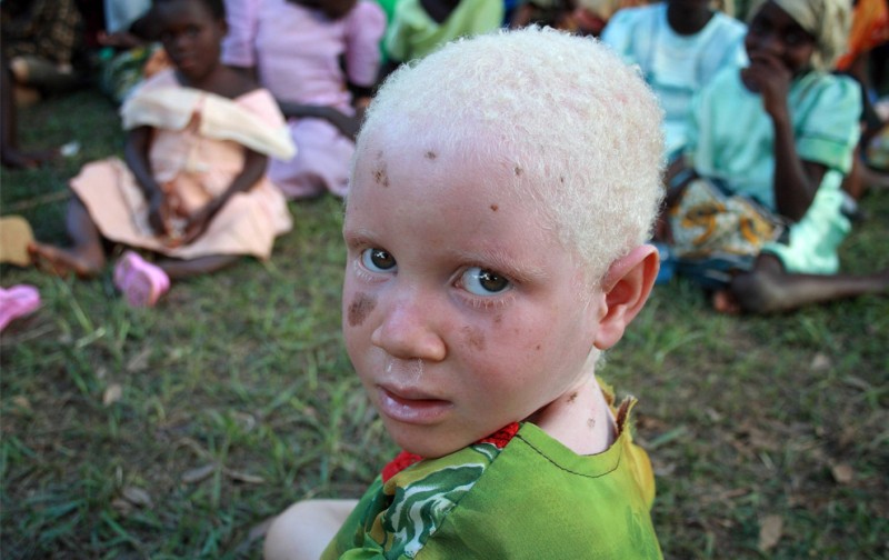 9) Ребенок-альбинос по время пикника, организованного Танзанийским Обществом Красного Креста (TRCS) в государственной школе для инвалидов в Кабанге, недалеко танзанийского города Кигома 5 июня, 2009. (REUTERS/Alex Wynter/IFRC/Handout)